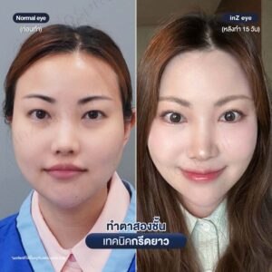ก่อนหลังทำตาสองชั้นกรีดยาวหมอหลิน-05/26