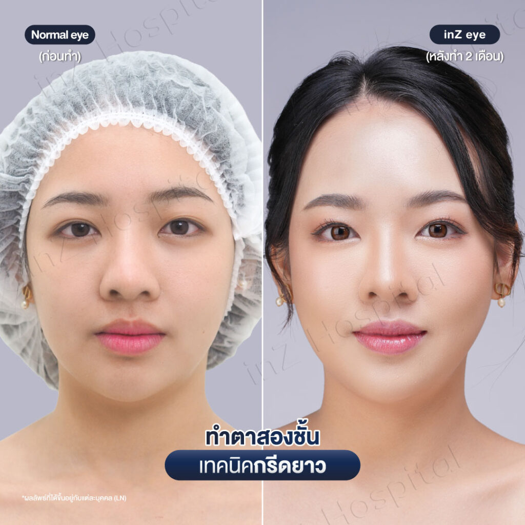 ก่อนหลังทำตาสองชั้นกรีดยาวหมอหลิน-01/26