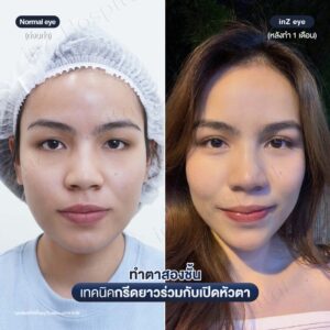 ก่อนหลังทำตาสองชั้นกรีดยาวหมอหลิน-06/26
