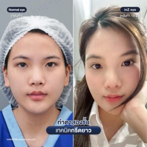 ก่อนหลังทำตาสองชั้นกรีดยาวหมอหลิน-03/26