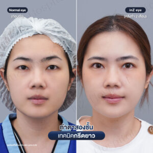 ก่อนหลังทำตาสองชั้นกรีดยาวหมอหลิน-04/26