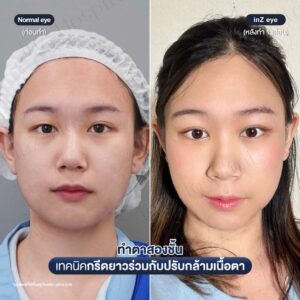 ก่อนหลังทำตาสองชั้นกรีดยาวหมอหลิน-07/26
