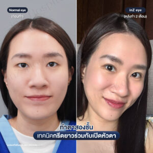 ก่อนหลังทำตาสองชั้นกรีดยาวหมอหลิน-02/26