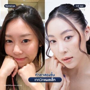 ตาสองชั้น-แผลเล็ก-หมอหลิน-03/26
