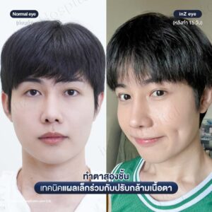 ตาสองชั้น-แผลเล็ก-หมอหลิน-08/26