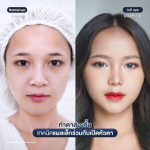 ตาสองชั้น-แผลเล็ก-หมอหลิน-06/26