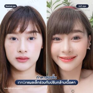 ตาสองชั้น-แผลเล็ก-หมอหลิน-04/26