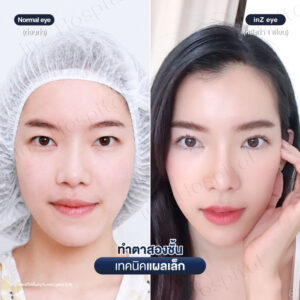 ตาสองชั้น-แผลเล็ก-หมอหลิน-05/26
