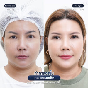 ตาสองชั้น-แผลเล็ก-หมอหลิน-07/26