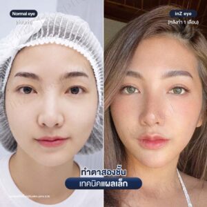 ตาสองชั้น-แผลเล็ก-หมอหลิน-02/26