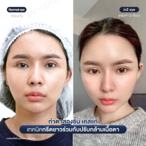 แก้ตาสองชั้นที่เคยทำมาก่อน-หมอหลิน-03/26