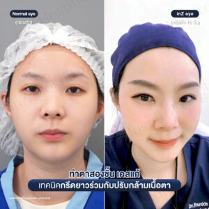 แก้ตาสองชั้นที่เคยทำมาก่อน-หมอหลิน-05/26