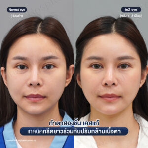 แก้ตาสองชั้นที่เคยทำมาก่อน-หมอหลิน-01/26