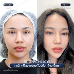 แก้ตาสองชั้นที่เคยทำมาก่อน-หมอหลิน-04/26