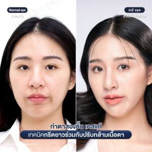 แก้ตาสองชั้นที่เคยทำมาก่อน-หมอหลิน-02/26