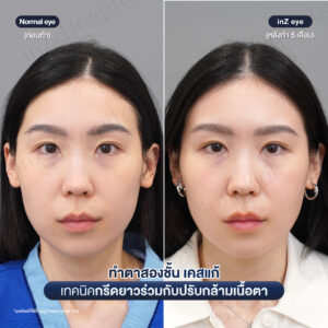 แก้ตาสองชั้นที่เคยทำมาก่อน-หมอหลิน-06/26