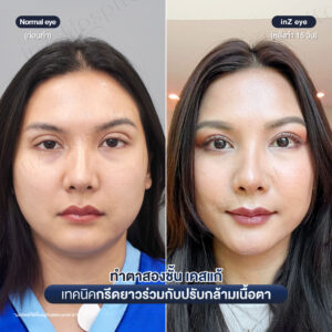 แก้ตาสองชั้นที่เคยทำมาก่อน-หมอหลิน-07/26