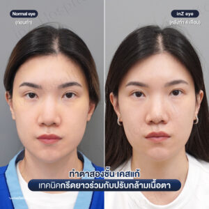 before&after-ทำตาสองชั้น-เคสแก้ตา-08/26