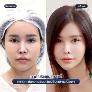 แก้ตาสองชั้นที่เคยทำมาก่อน-หมอหลิน-09/26