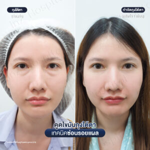 ดูดไขมันถุงใต้ตา หมอหลิน-06/26