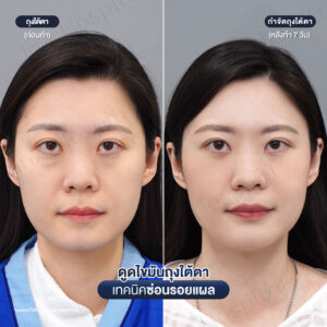 ดูดไขมันถุงใต้ตา หมอหลิน-04/26