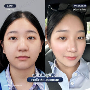 ดูดไขมันถุงใต้ตา หมอหลิน-05/26