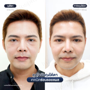 ดูดไขมันถุงใต้ตา หมอหลิน-07/26