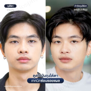 ดูดไขมันถุงใต้ตา หมอหลิน-02/26