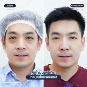 ดูดไขมันถุงใต้ตา หมอหลิน-03/26