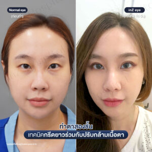 ก่อนหลังทำตาสองชั้น เปิดหัวตาหมอหลิน-02/26