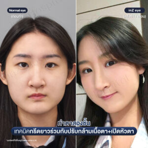 ก่อนหลังทำตาสองชั้น เปิดหัวตาหมอหลิน-04/26