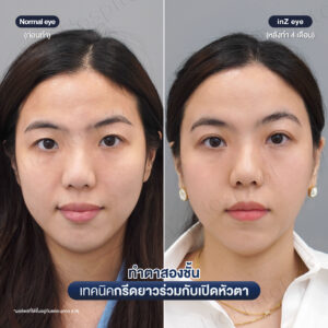 ก่อนหลังทำตาสองชั้น เปิดหัวตาหมอหลิน-05/26