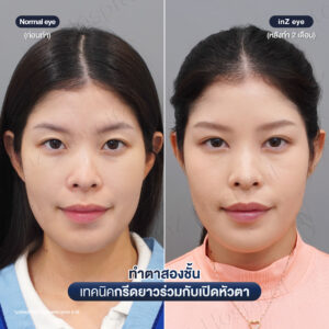 ก่อนหลังทำตาสองชั้น เปิดหัวตาหมอหลิน-06/26