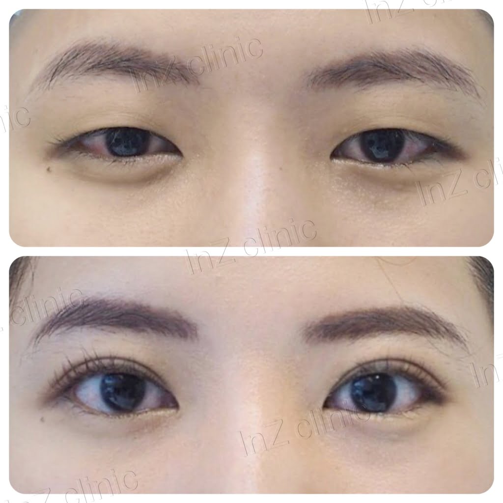 Current methods of double eyelid surgery, pros & cons