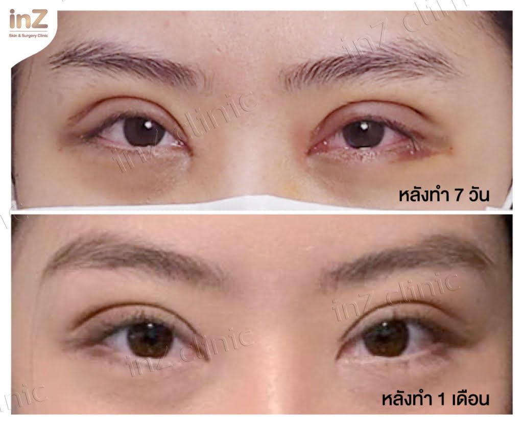 ภาพตัวอย่างอาการบวมช้ำรอบดวงตา หลังจากทำตาสองชั้น