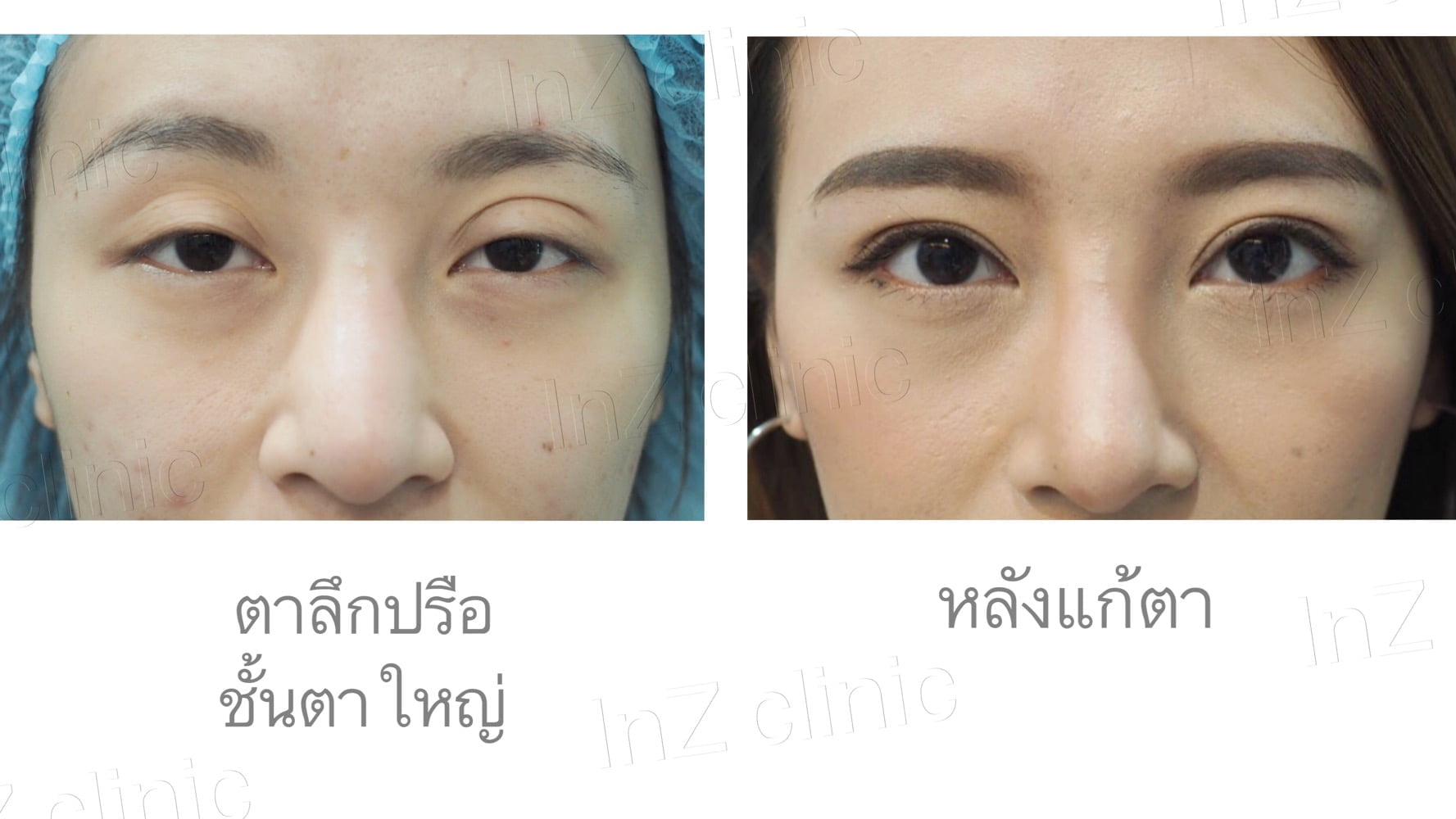 Current methods of double eyelid surgery, pros & cons inZ Clinic