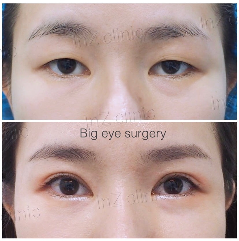 คนตาเล็ก ทำให้ตาโตขึ้นด้วย Big eye surgery 05
