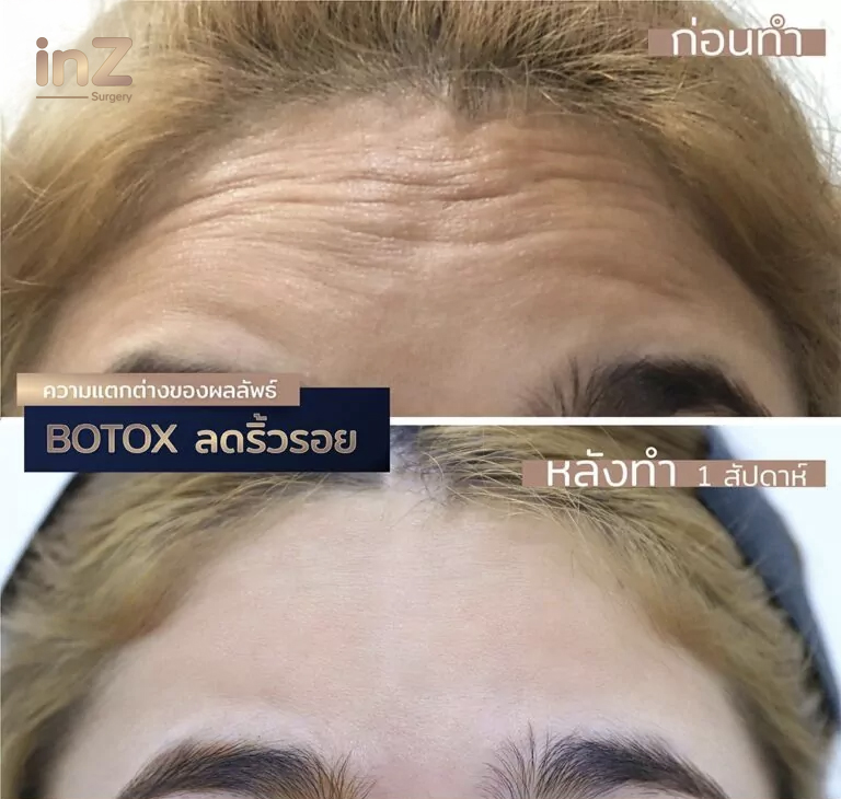 สารคลายกล้ามเนื้อ (ฉีดโบ) ประโยชน์แน่นเต็มขวด