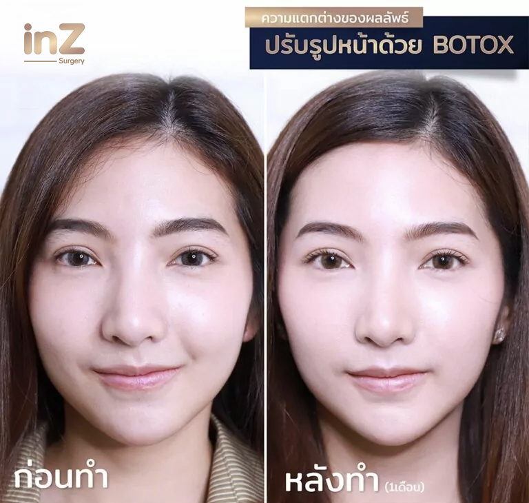 สารคลายกล้ามเนื้อ (ฉีดโบ) ประโยชน์แน่นเต็มขวด