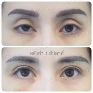 ตาสองชั้นแผลเล็ก
