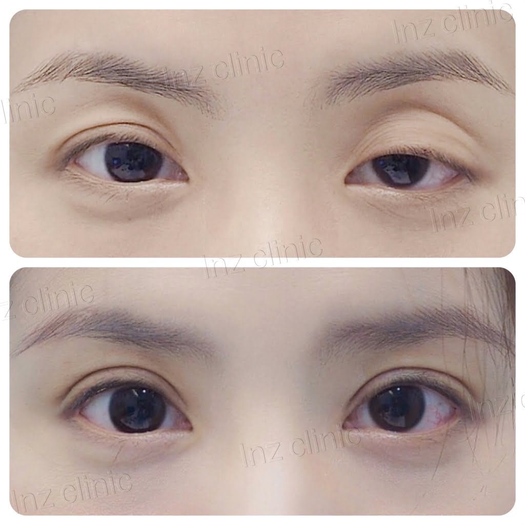 ตาไม่เท่ากัน แก้ไขโดย ผ่าตัดปรับกล้ามเนื้อตาทั้ง 2 ข้าง