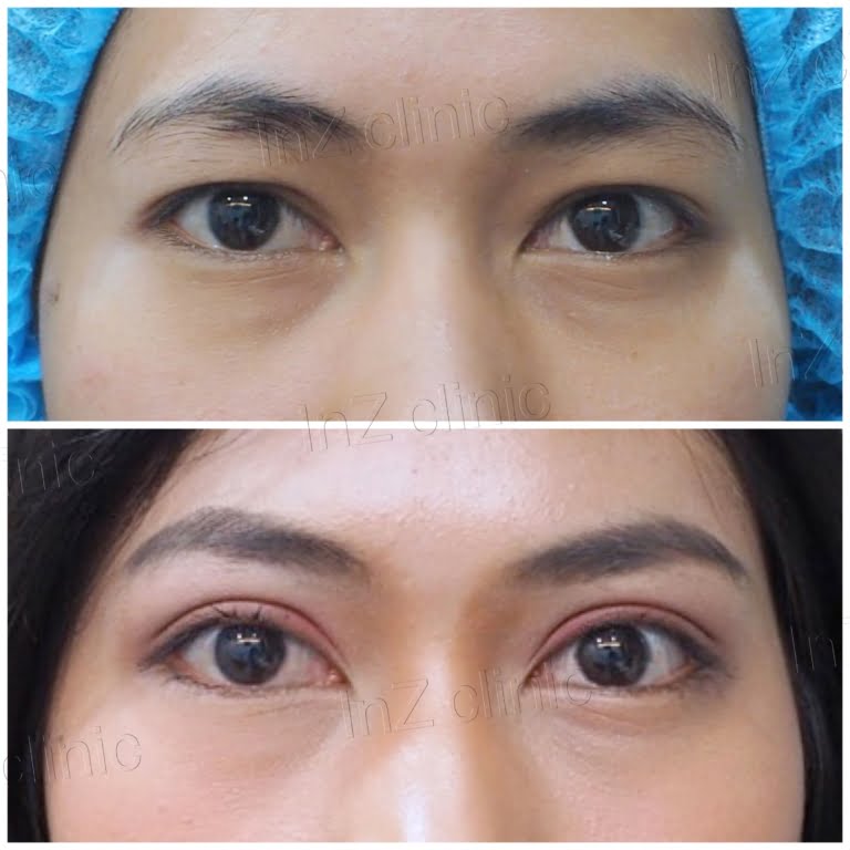 Current methods of double eyelid surgery, pros & cons inZ Clinic