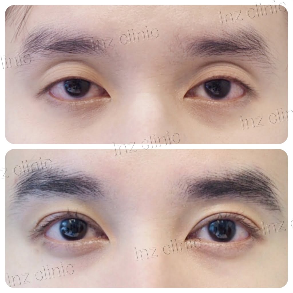 Current methods of double eyelid surgery, pros & cons
