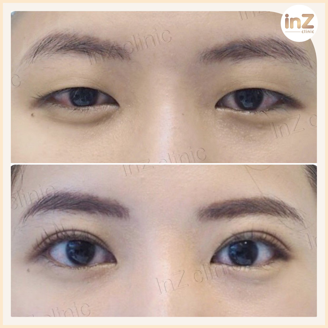 ทำตาสองชั้น-2