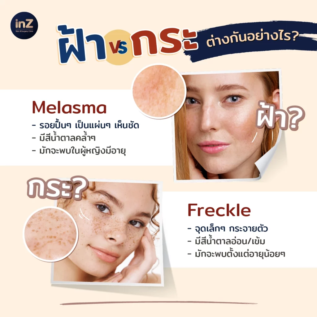 ฝ้า VS กระ ต่างกันอย่างไร - inZ Clinic