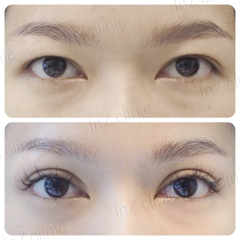 Current methods of double eyelid surgery, pros & cons inZ Clinic