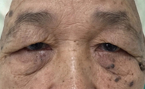 การทำศัลยกรรมตา ในคนสูงอายุ