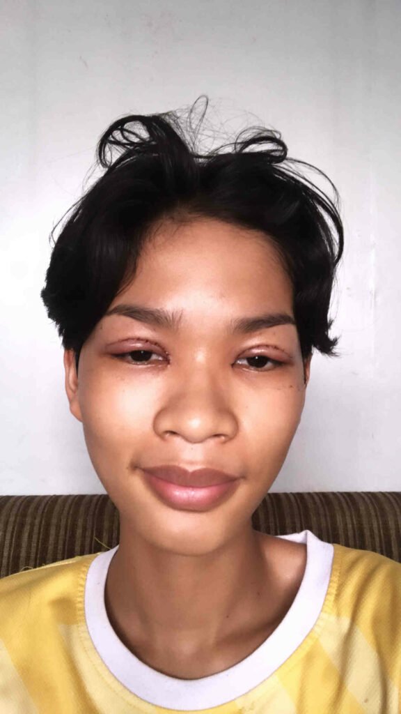 รีวิวตาสองชั้น_คุณป๊อกแป๊ก_Big eye surgery04