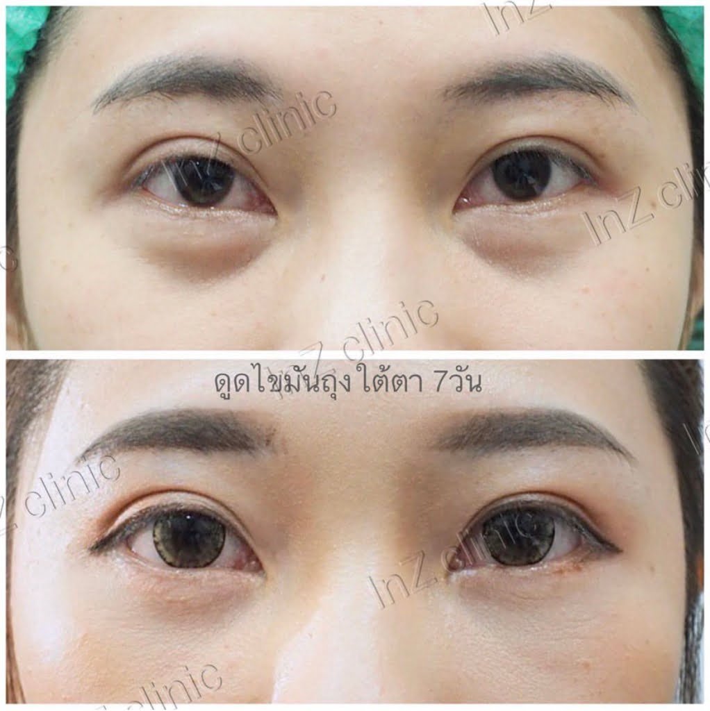 อาการถุงใต้ตาจากกล้ามเนื้อ_หรือ_Dolly_eye