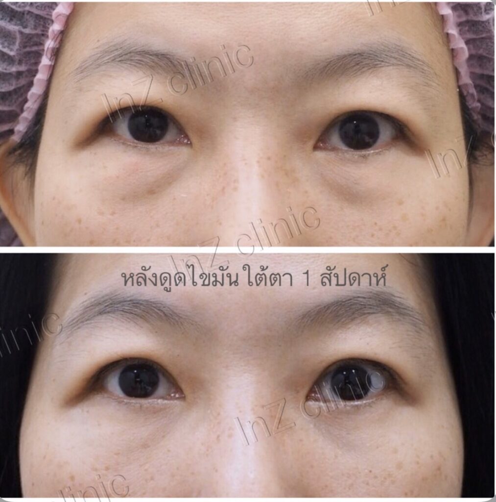 ผ่าตัดลดถุงใต้ตา แก้ไขอย่างไร_04